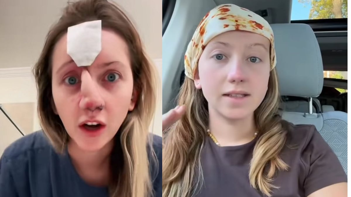 Após 16 cirurgias, mulher que teve nariz arrancado por cachorro surge com nova aparência